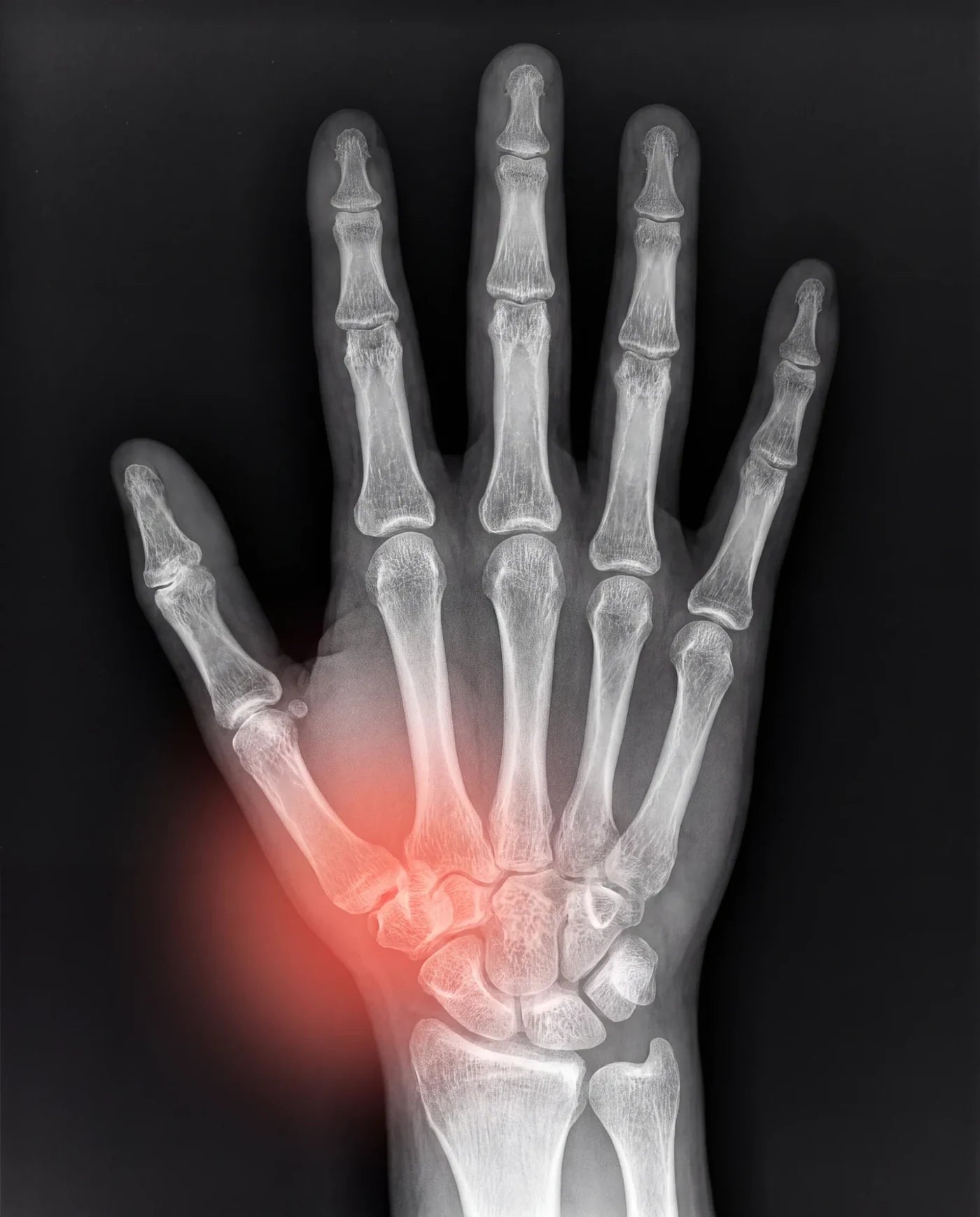 X-ray style illustration of the inflamed joint at the base of the thumb