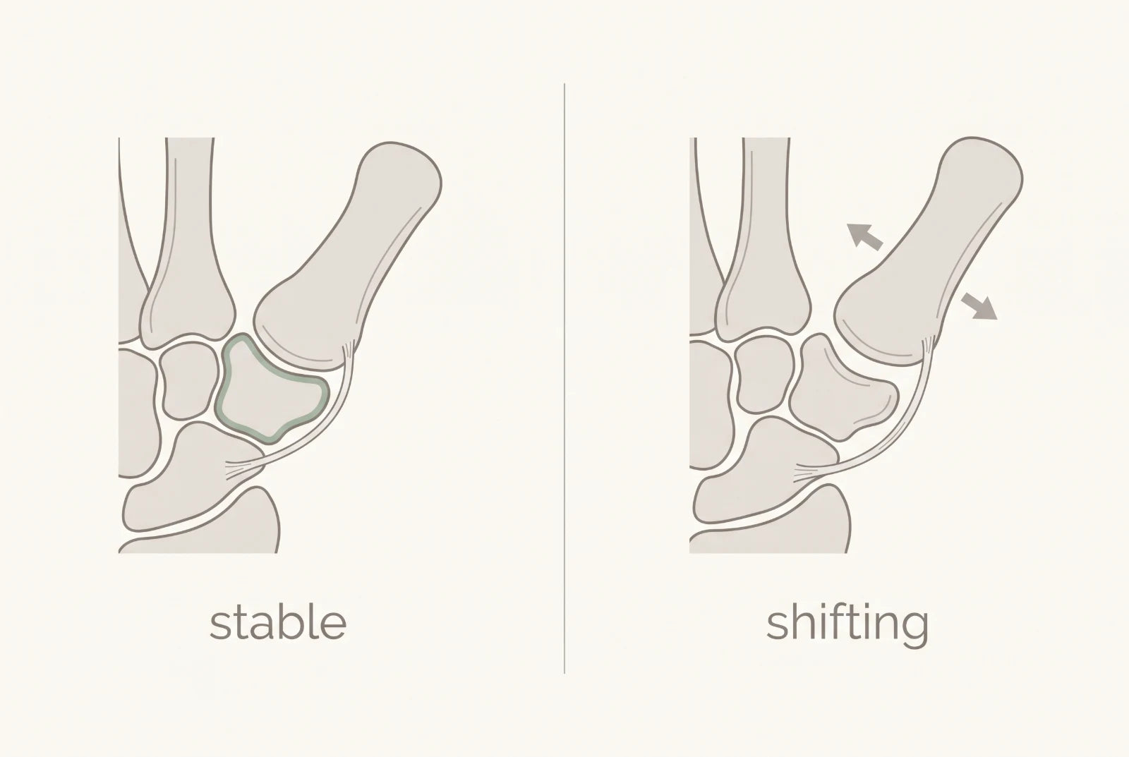 Diagram comparing a stable thumb base joint with the same joint shifted out of position